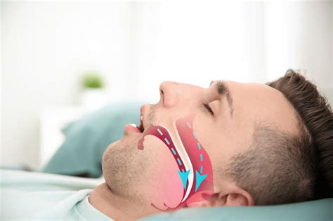 SLEEP APNEA .